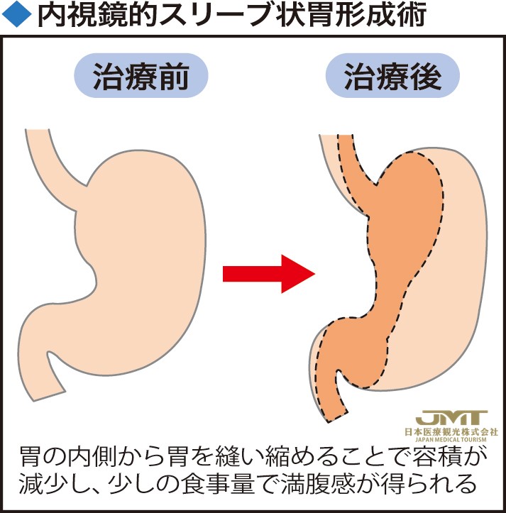 JMT日本医疗——用内窥镜缩小胃，不留创伤的减重手术