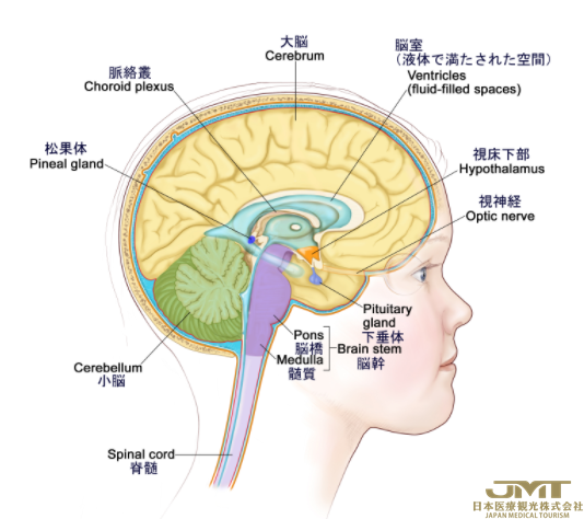 JMT日本医疗——儿童颅内生殖细胞瘤的症状及诊断①