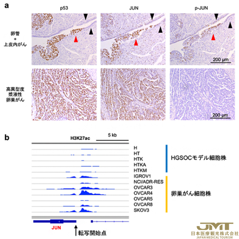 JMT日本医疗——日本阐明了卵巢癌的致癌机制③